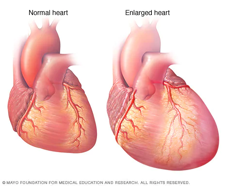 ds00061  ds00519 im04248 mcdc7 enlargedheartthu jpg - علائم نارسایی قلبی در بزرگسالان