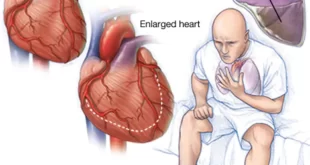 mcdc7 heart failure 310x165 - علائم نارسایی قلبی در بزرگسالان