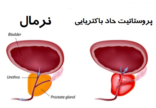 پروستاتیت حاد باکتریایی - مشکلات پروستات