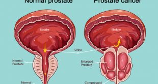 مشکلات پروستات 1 310x165 - مشکلات پروستات