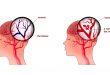 Stroke 110x75 - علائم سکته مغزی و پیشگیری از آن