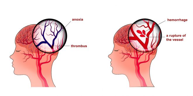 Stroke 660x330 - علائم سکته مغزی و پیشگیری از آن