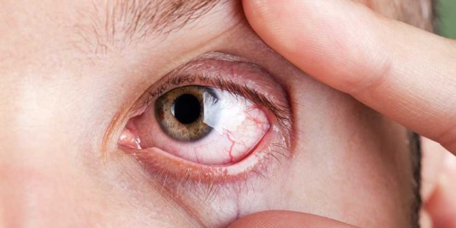 1 32 660x330 - درمان خانگی خشکی چشم