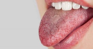 dry mouth 310x165 - کمبود کدام ویتامین باعث خشکی دهان میشود