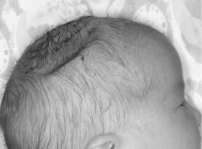 fetalneonatal 2009 March 94 2 F137 F1.large  - ضربه خوردن به سر و حالت تهوع
