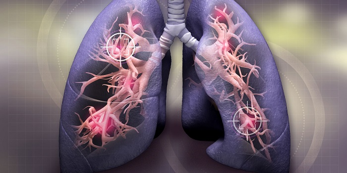 lung cancer main - سرطان ریه تا چه حد قابل درمان است