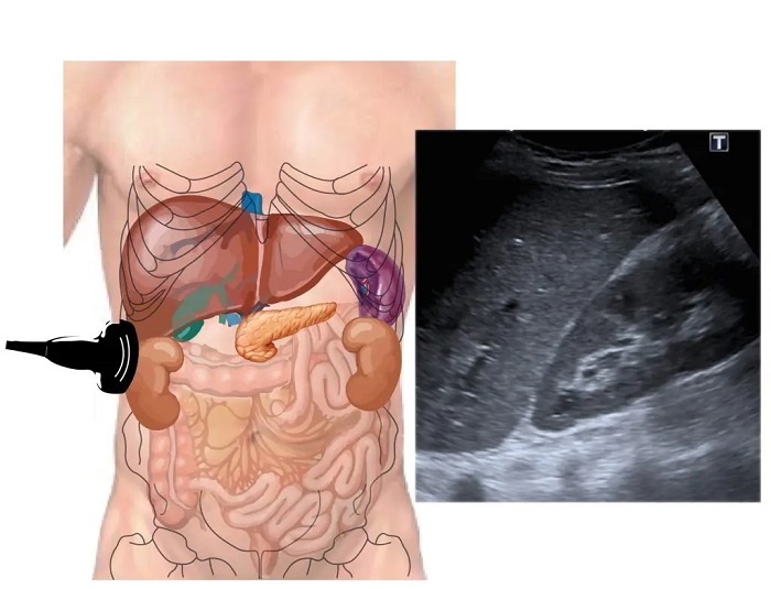 RadiologyExpert English class ultrasound abdomen general fig2 Technique liver BLANCO 1024x784 1 - اکوی پارانشیم کبد افزایش یافته یعنی چه